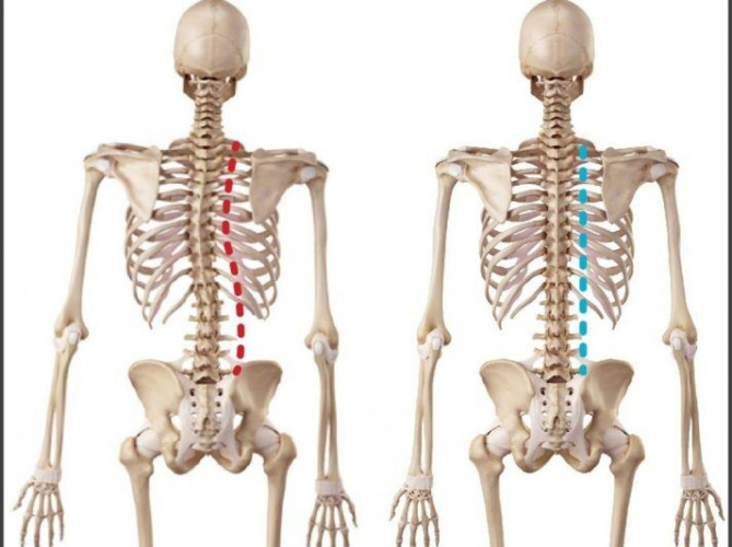 ناهنجاری ساختار اسکلتی تهدید جدی در سلامت زنان است .