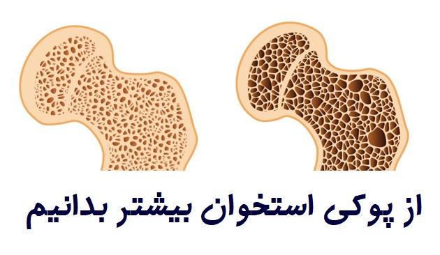 دانستنی های سلامت با موضوع پوکی استخوان+ فیلم