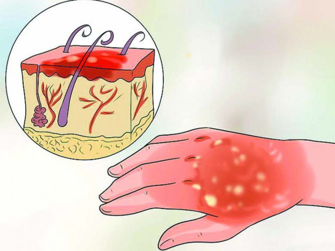 سوختگی+ فیلم