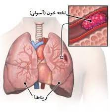 آمبولی چیست؟